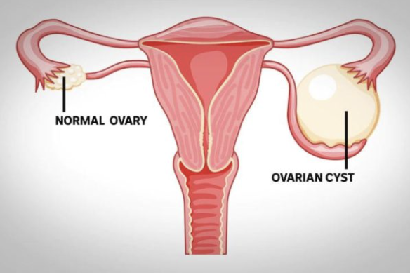 Breast Lump Evaluation - Specialist Gynaecology Treatment at First Care Clinic